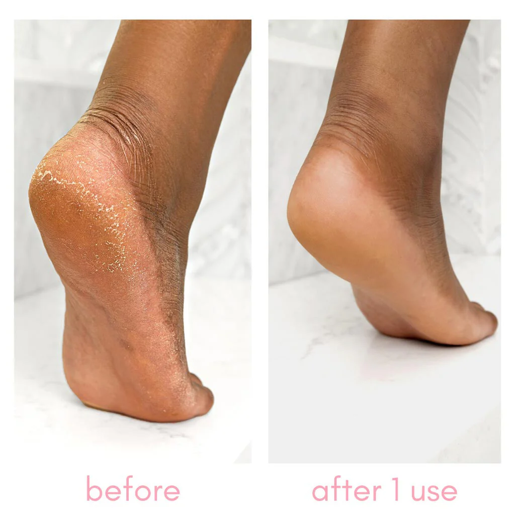 Heel-ing Callus Remover - Image 3