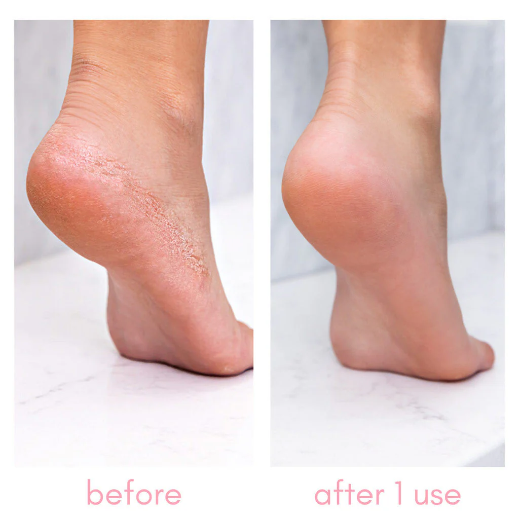 The Heel-ing Callus Remover Kit - Image 5