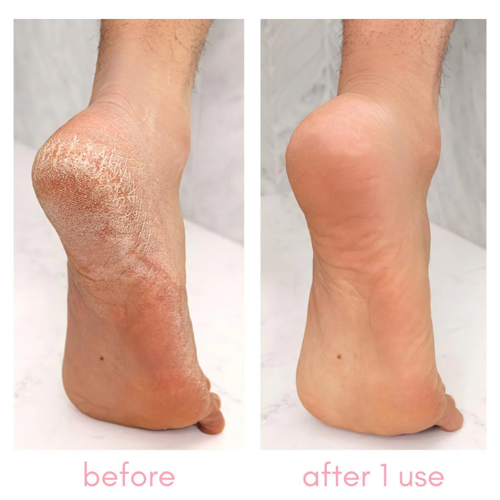 The Heel-ing Callus Remover Kit - Image 7